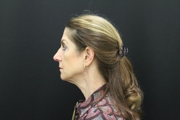 Face & Neck Lifts Case 1 - Before