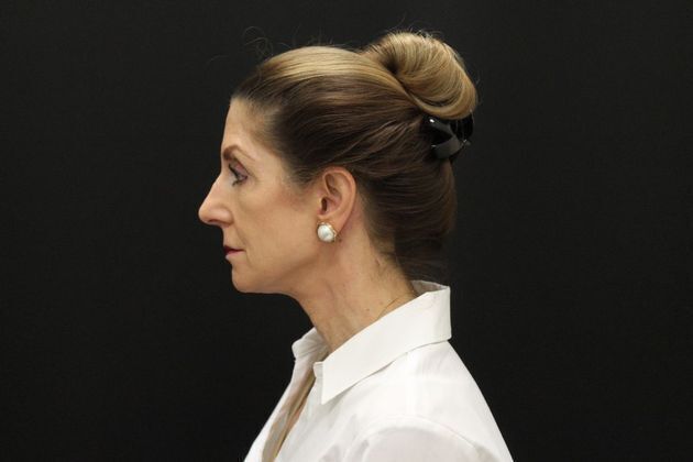 Face & Neck Lifts Case 1 - After