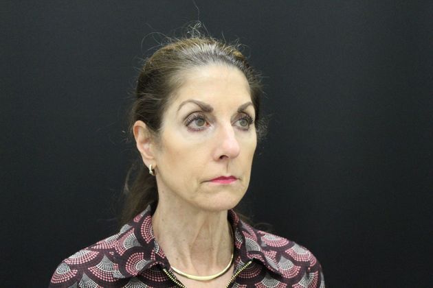 Face & Neck Lifts: Case 1 - Before