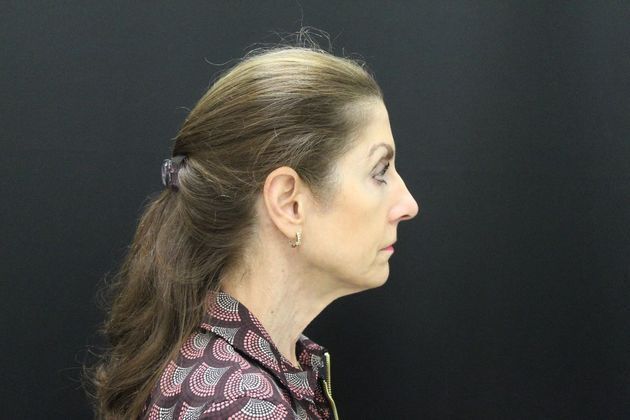 Face & Neck Lifts: Case 1 - Before