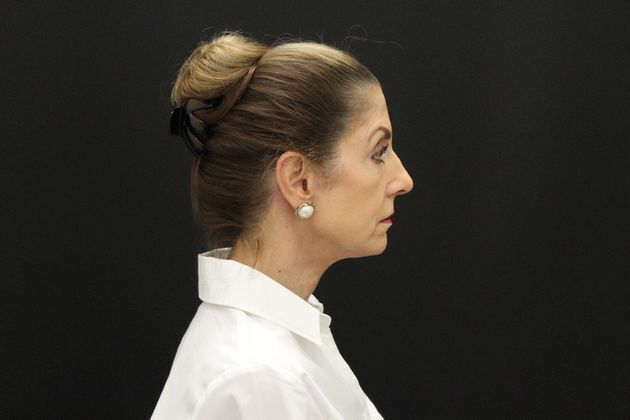 Face & Neck Lifts: Case 1 - After