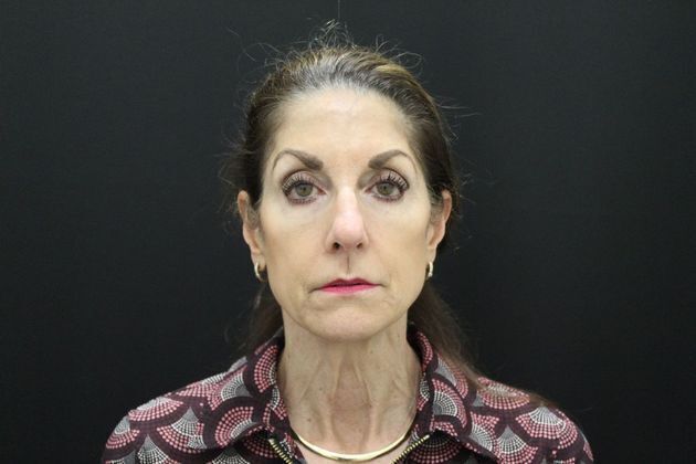 Face & Neck Lifts: Case 1 - Before