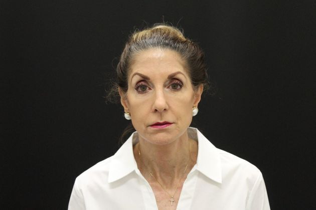 Face & Neck Lifts: Case 1 - After