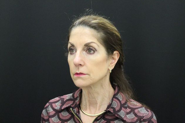 Face & Neck Lifts: Case 1 - Before