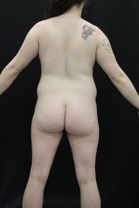 Brazilian Butt Lift Case 1 - Before