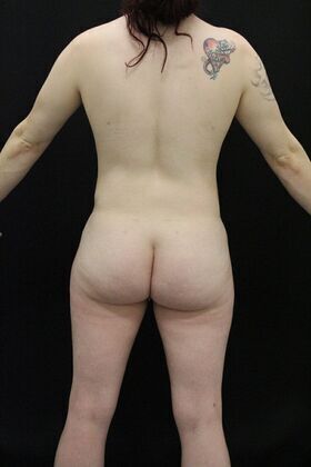 Brazilian Butt Lift Case 1 - After