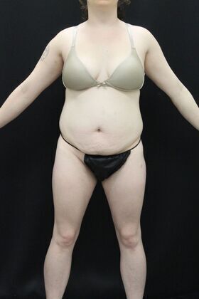 Brazilian Butt Lift: Case 1 - Before