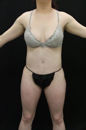 Brazilian Butt Lift: Case 1 - After