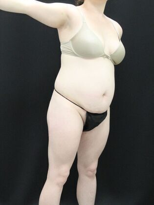 Brazilian Butt Lift: Case 1 - Before