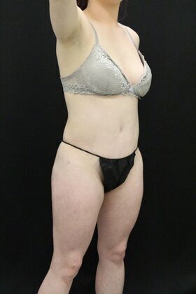 Brazilian Butt Lift: Case 1 - After