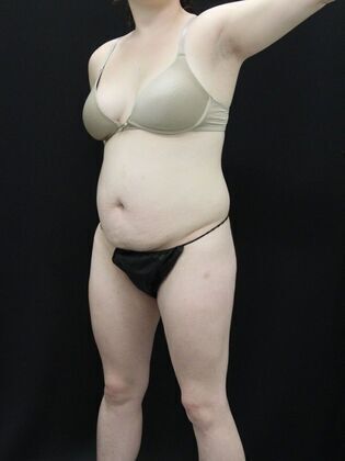 Brazilian Butt Lift: Case 1 - Before