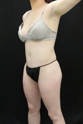 Brazilian Butt Lift: Case 1 - After