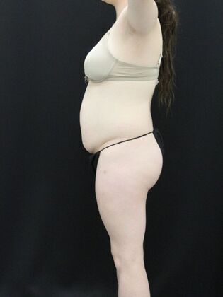 Brazilian Butt Lift: Case 1 - Before