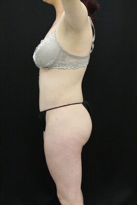 Brazilian Butt Lift: Case 1 - After