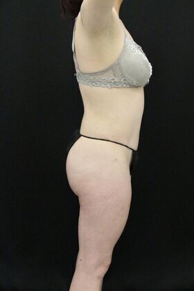 Brazilian Butt Lift: Case 1 - After