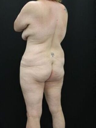 Brazilian Butt Lift: Case 2 - Before