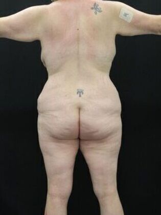 Brazilian Butt Lift Case 2 - Before