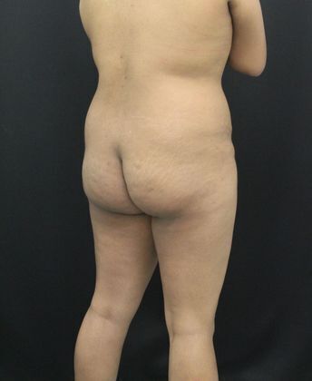 Brazilian Butt Lift Case 4 - Before