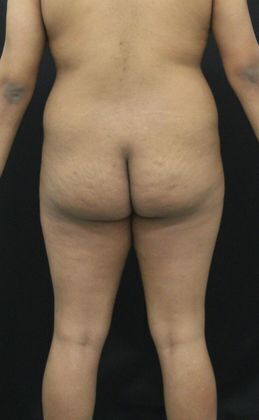 Brazilian Butt Lift: Case 4 - Before