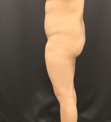 Brazilian Butt Lift: Case 4 - Before