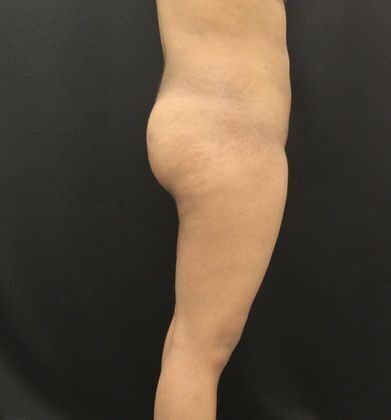 Brazilian Butt Lift: Case 4 - After