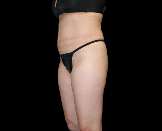 Brazilian Butt Lift: Case 5 - Before