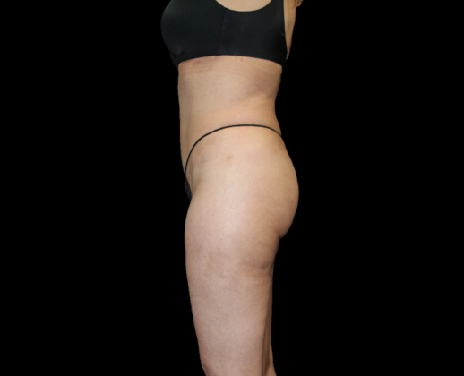 Brazilian Butt Lift: Case 5 - After