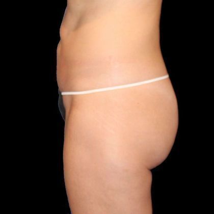 Brazilian Butt Lift: Case 6 - Before