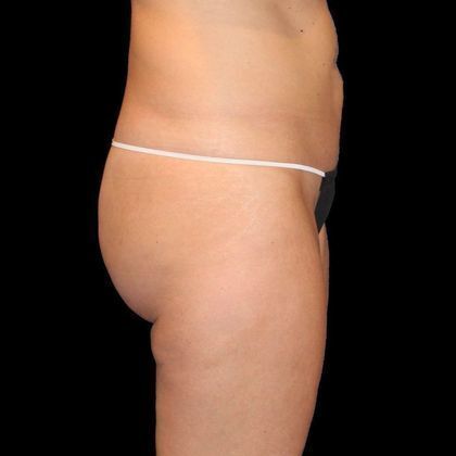 Brazilian Butt Lift: Case 6 - Before