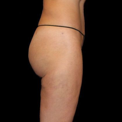 Brazilian Butt Lift: Case 6 - After