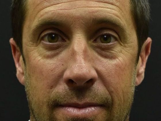 Eyelid Surgery Case 1 - Before