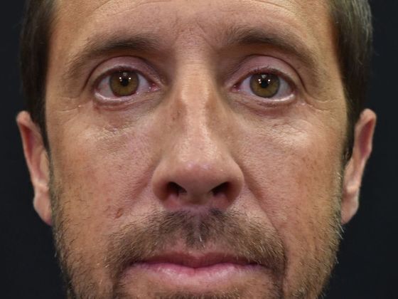 Eyelid Surgery Case 1 - After