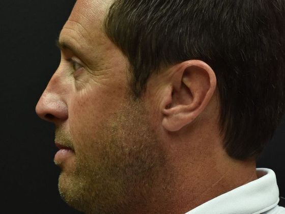 Eyelid Surgery: Case 1 - Before