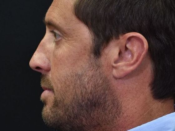 Eyelid Surgery: Case 1 - After