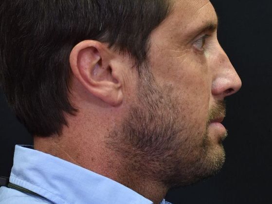 Eyelid Surgery: Case 1 - Before