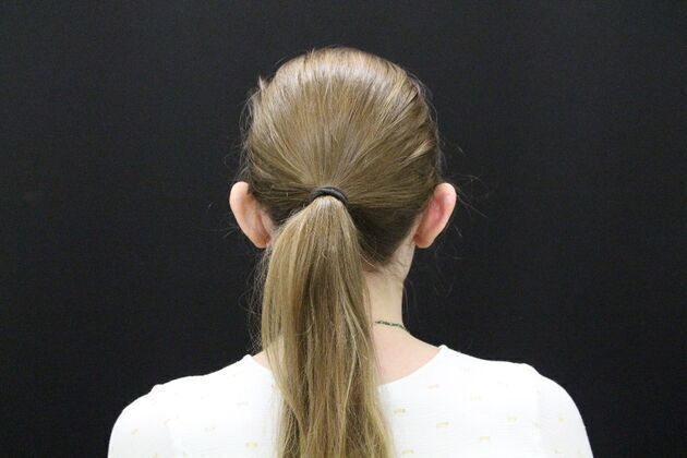 Otoplasty: Case 1 - Before