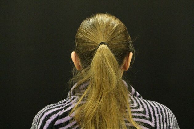 Otoplasty: Case 1 - After