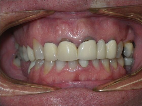 Cosmetic Changes with Veneers and Crown and Bridge: Case 5 - Before