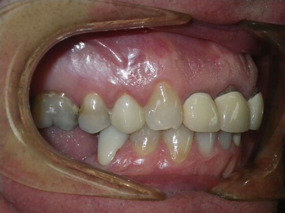 Cosmetic Changes with Veneers and Crown and Bridge: Case 5 - Before