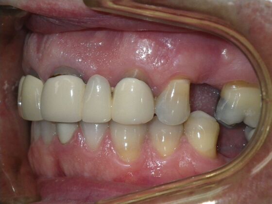 Cosmetic Changes with Veneers and Crown and Bridge: Case 5 - Before