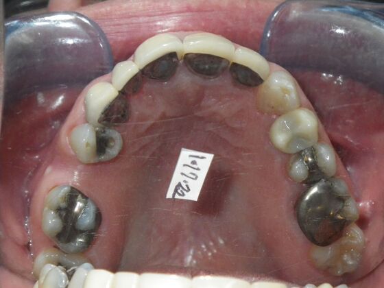 Cosmetic Changes with Veneers and Crown and Bridge: Case 5 - Before
