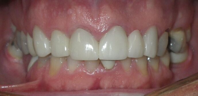 Cosmetic Changes with Veneers and Crown and Bridge: Case 5 - After