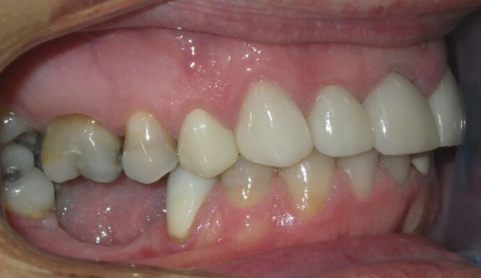 Cosmetic Changes with Veneers and Crown and Bridge: Case 5 - After