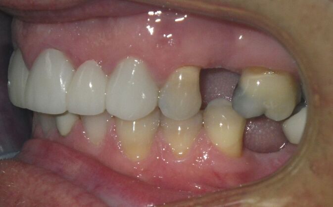 Cosmetic Changes with Veneers and Crown and Bridge: Case 5 - After
