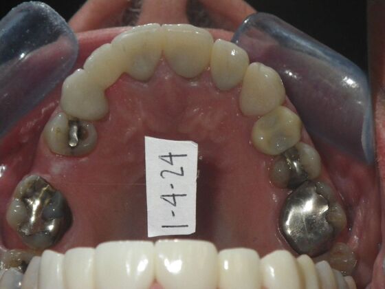 Cosmetic Changes with Veneers and Crown and Bridge: Case 5 - After