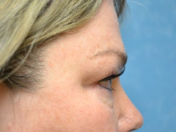 Eye Lift (Blepharoplasty): Case 1770- Sylvania, OH - Before