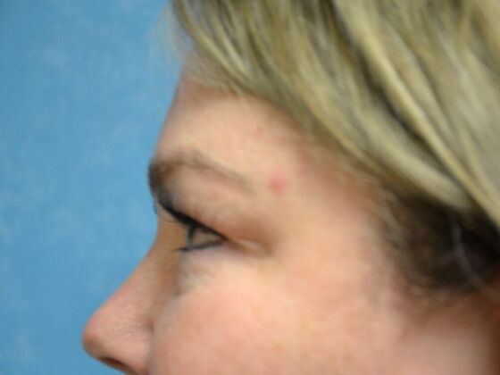 Eye Lift (Blepharoplasty): Case 1770- Sylvania, OH - Before