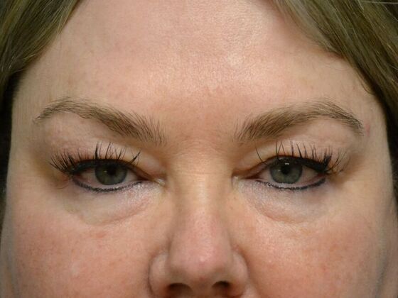 Eye Lift (Blepharoplasty) Case 1770- Sylvania, OH - Before