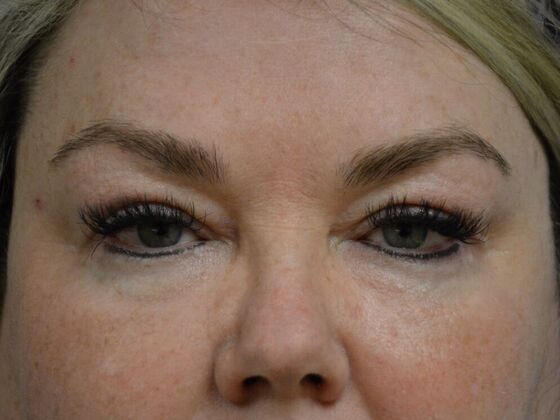 Eye Lift (Blepharoplasty) Case 1770- Sylvania, OH - After