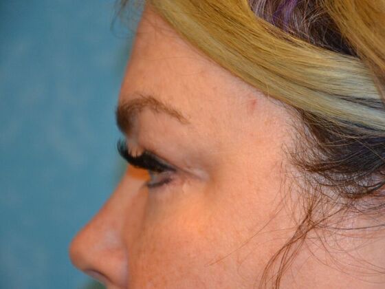 Eye Lift (Blepharoplasty): Case 1770- Sylvania, OH - After